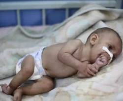 عجزت الأمم المتحدة عن إخراجه.. وفاة طفل آخر في غوطة دمشق المحاصرة